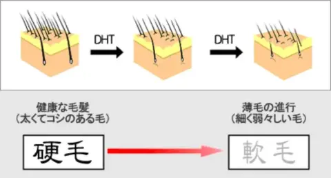 フィナステリドとデュタステリドの抗AGA効果はDHTの抑制にある